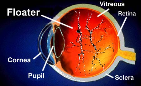 Diagram of the eye, with floaters