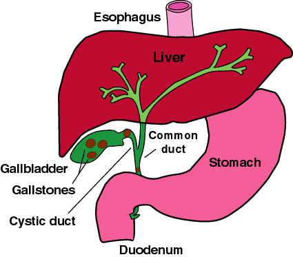 12Mm Gallstone Diet