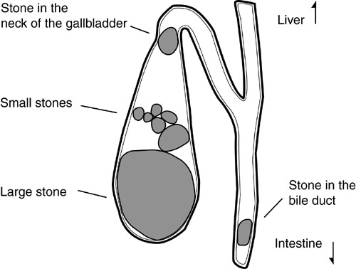 12Mm Gallstone Diet